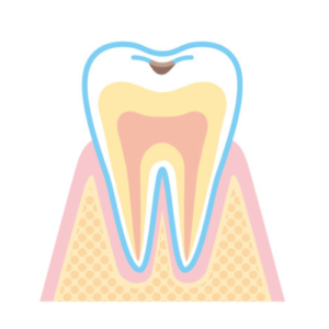 C1：エナメル質の虫歯​