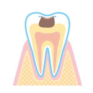 C2：象牙質の虫歯​