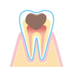 C3：歯髄（神経）に達する虫歯​