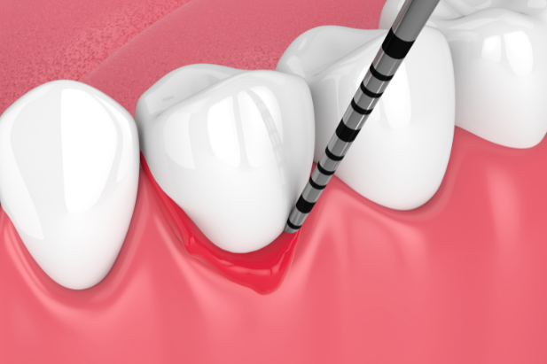 歯周病の症状と原因​