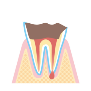 C4：歯根に達する虫歯​